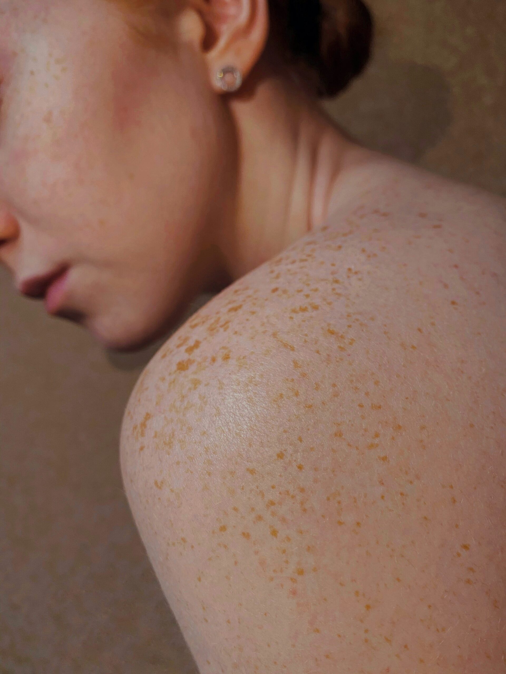 Peeling
